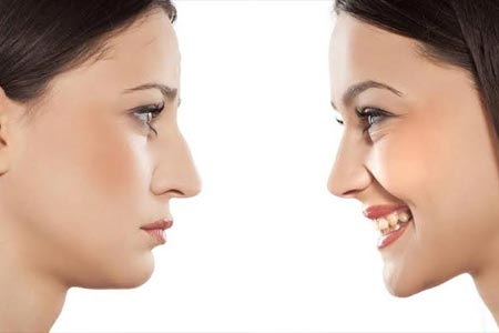 Functional Rhinoplasty