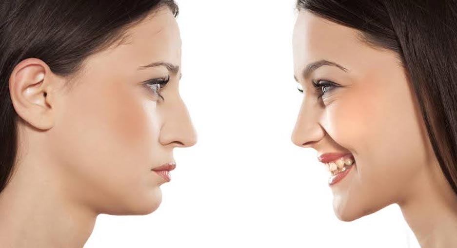 Functional Rhinoplasty