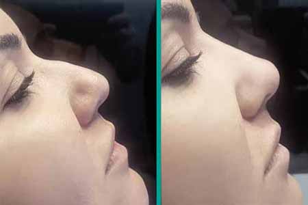 Non-Surgical Rhinoplasty