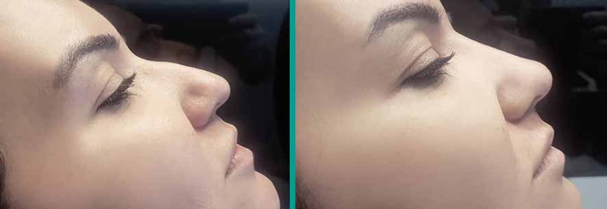 Non-Surgical Rhinoplasty