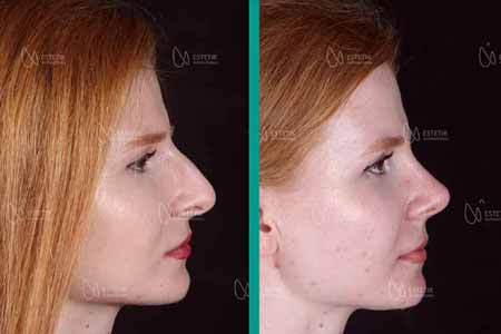 Rhinoplasty (Nose Aesthetic)