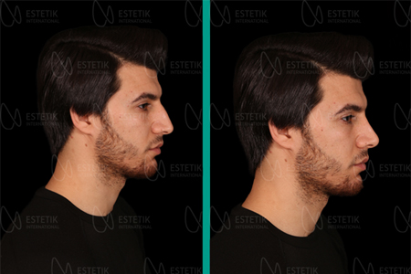 Rhinoplasty (Nose Aesthetic)