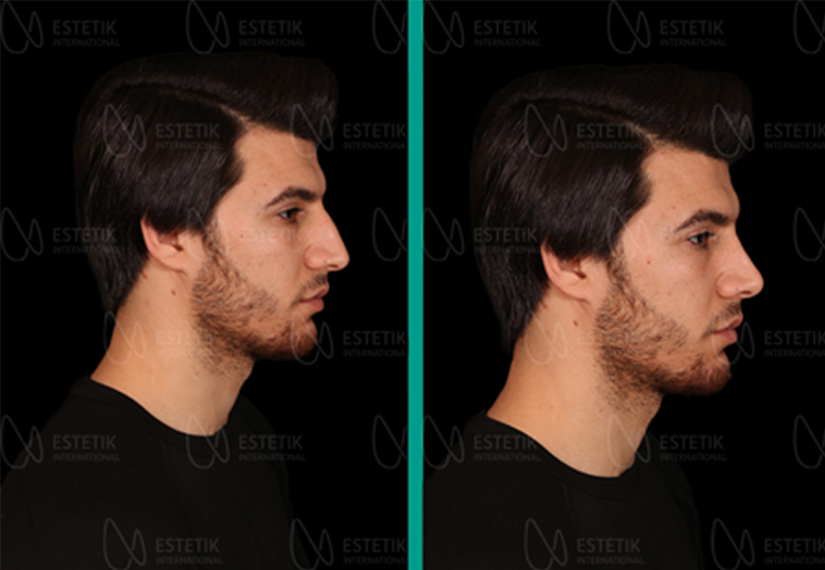 rhinoplasty