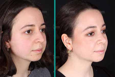 Simple Rhinoplasty