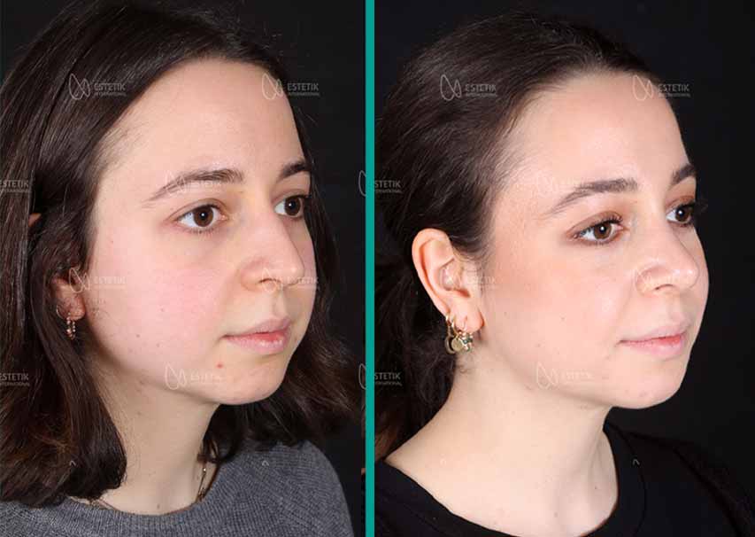 Simple Nose Aesthetics (Rhinoplasty)