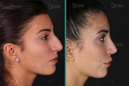 Ultrasonic Rhinoplasty